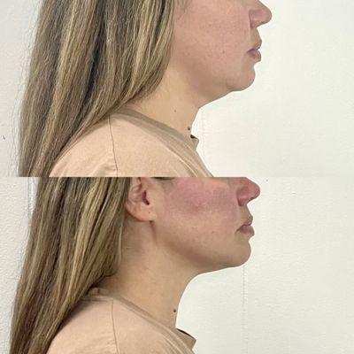 Radiofrequency Skin Tightening Treatment