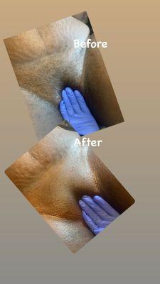 Before and after Brazilian