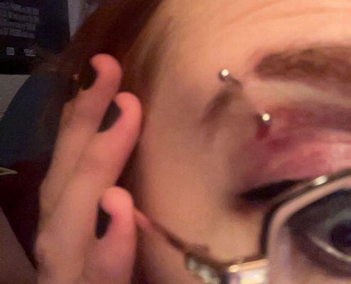 LOOK AT THE PLACEMENT & BRUISING. This piercer is NOT qualified.