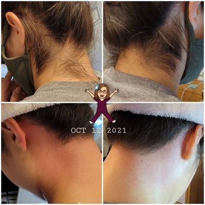 Sugared this client's hairline