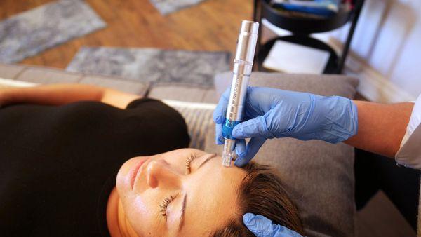 SF Microneedling