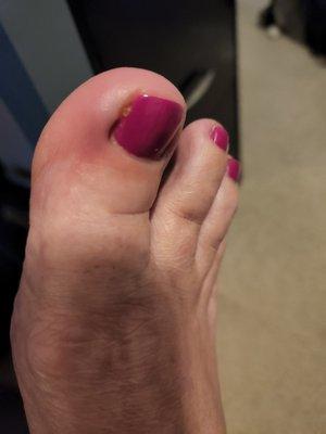 redness and swelling, feverish