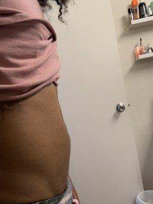 After two months of treatments