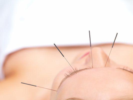 An Acupuncture Approach
