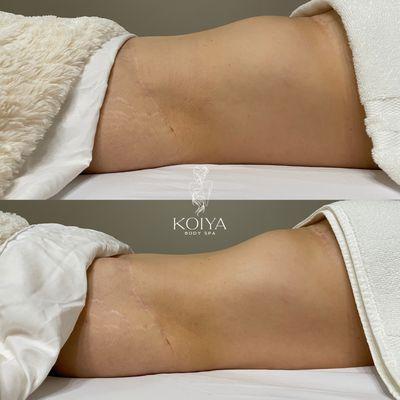 Client had tummy tuck surgery 6 years ago & found us to continue her lymphatic drainage sessions. Post care is still vital for maintenance.
