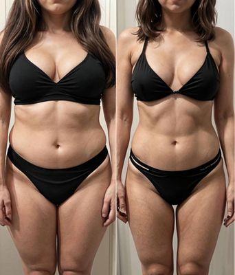 Roller lymphatic drainage massage