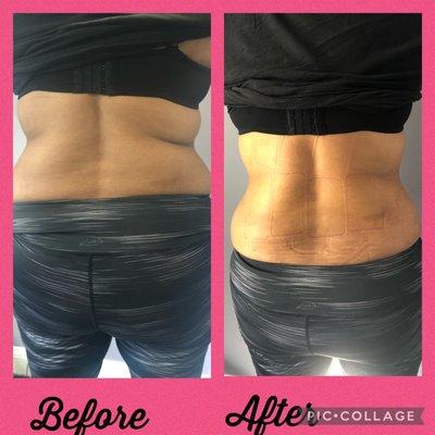 Laser Lipo