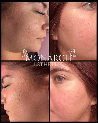 10 days post acne scar revision (first treatment)