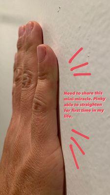 Shows side view of my hand against a wall for reference... with my pinky straightened! Never been able to do this!