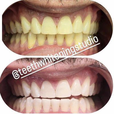 Before and after a 60 min whitening session.