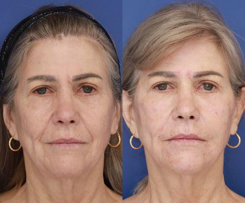 Best Filler Injector Education Center