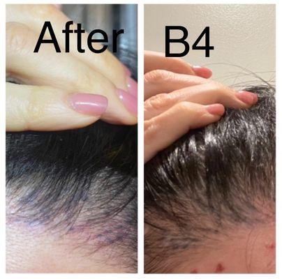 Before and after of tattoo "removal"