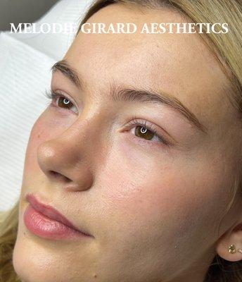 HydroFacial, Microneedling