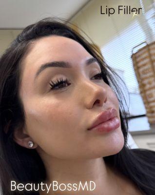 Dermal Filler to help enhance the lips, cheeks, and Jawline.