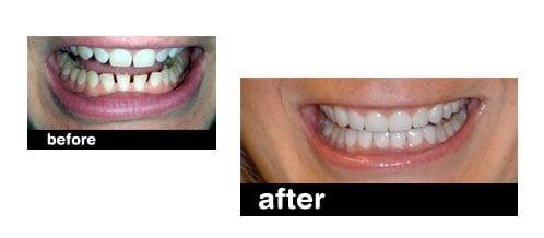 Porcelain Veneers where used to give this wonderful person something to smile about.