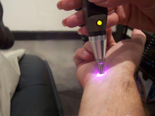 Freedom Laser's low-level laser procedure targeting acupuncture points on wrist