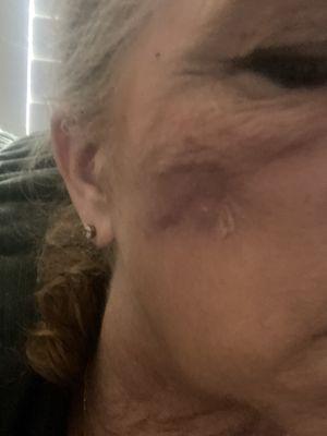 Facial filler lumps lasting more than 2 months