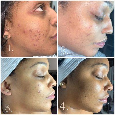 Results after four treatments