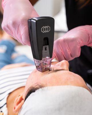 Morpheus8 treatment.