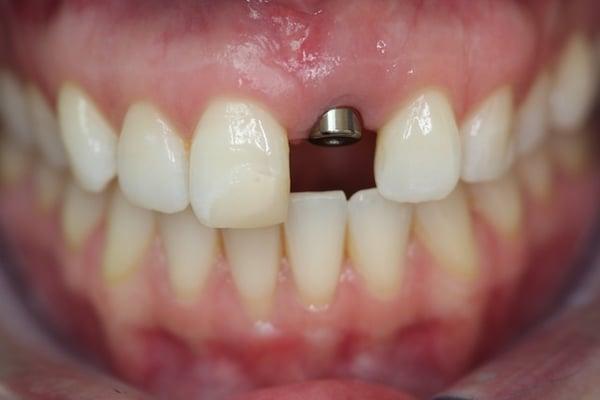 Before photo of an implant case. The missing tooth and the adjacent tooth were restored with porcelain crowns.