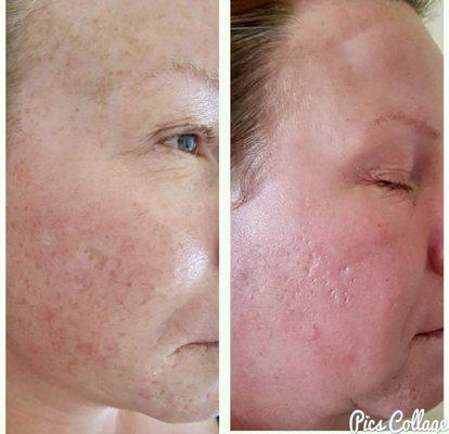 Another Elaine Brennan Skin Renewal Peeling System before and after photo