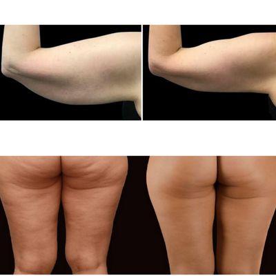 Ultrasonic Cavitation and RF therapy