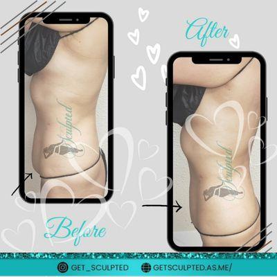 Non-invasive body Sculpting results