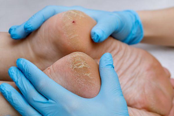 Our podiatrists are ready to help heal your cracked heels and keep your feet looking and feeling their best.