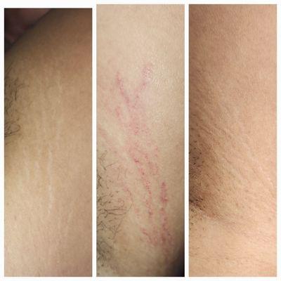 Inkless stretchmarks camoflauge treatment on back of arm. Before on left, healed in right.