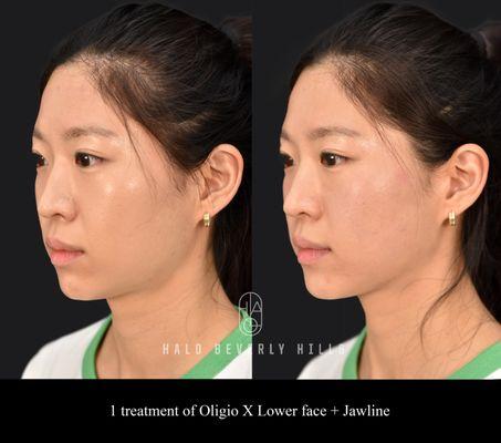 Oligio X for lower face and jawline tightening and lifting