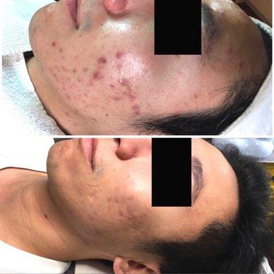 Acne Specialists of Nashville
