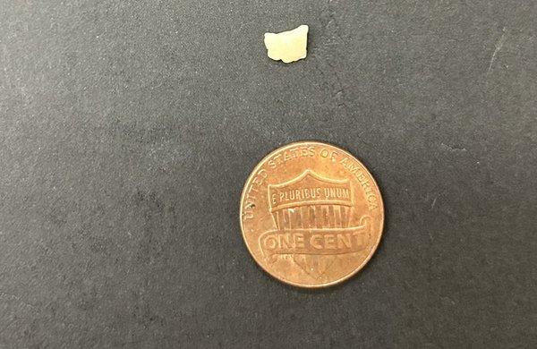 Broken tooth after filling