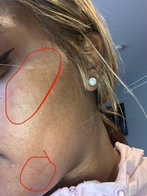 circled the burns and irritation on left side