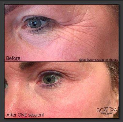 FIBROBLAST ONE SESSION RESULTS!