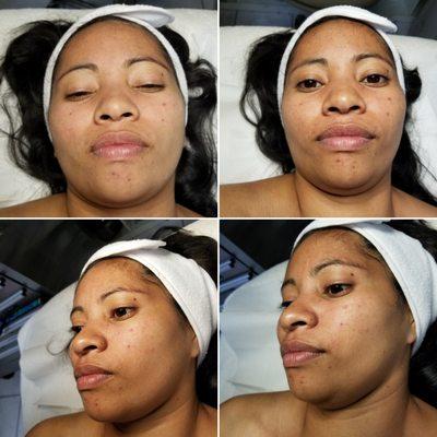 Before and after Microdermabrasion peel