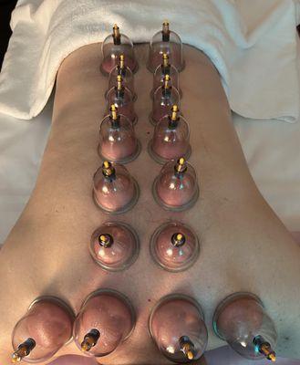 Cupping session