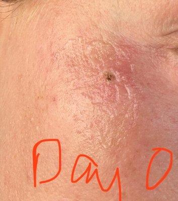 Spider Vein less than 5cm