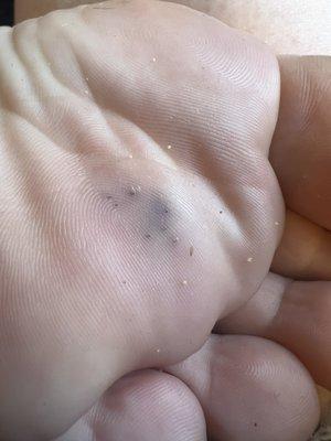 Some of the spines. In his toes too. This was through water shoes