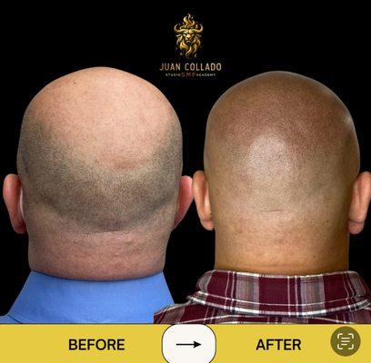 SMP crown transformation -- restored fullness and coverage for a natural finish. Realistic density work. Queens, New York.