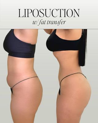Liposuction 360 with fat transfer to the buttocks.