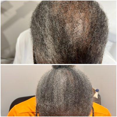 Hair PRP Treatment