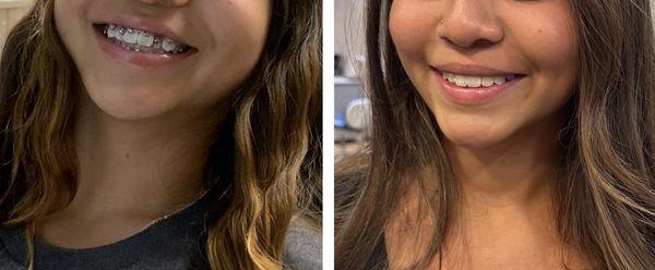 Before and after w/ smile arc