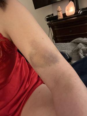 Bruises