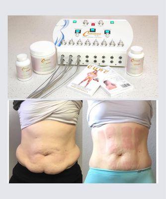 The OS2911Body Device, (FDA cleared) will transform your body in 10 painless and holistic sessions! Walk that wiggle with a lot less jiggle!