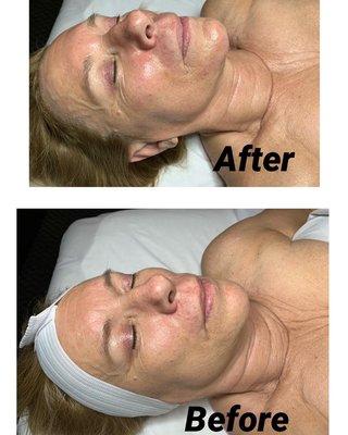 Chemical peel