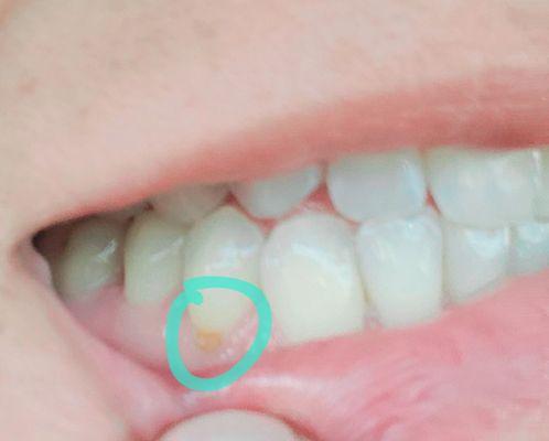 Cavity on my lower part of my cuspid.
