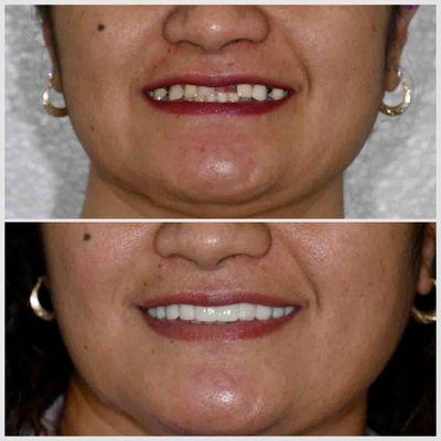 She wanted a fuller, more natural smile. With crowns and implants, we brought it to life. Every smile is unique--contact Dental Lounge.