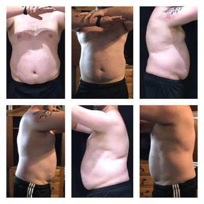 Coolsculpting success pictures