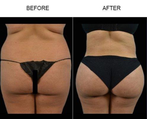 Tampa Liposuction by Bassin