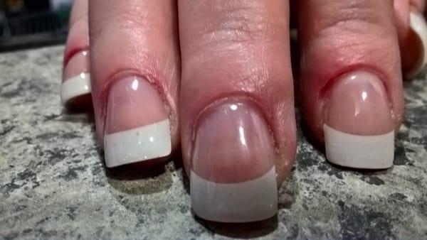 This is the day after. It looked worse yesterday. Pinky keeps bleeding if touched. Very painful. Nails are crooked w/ spots inside.